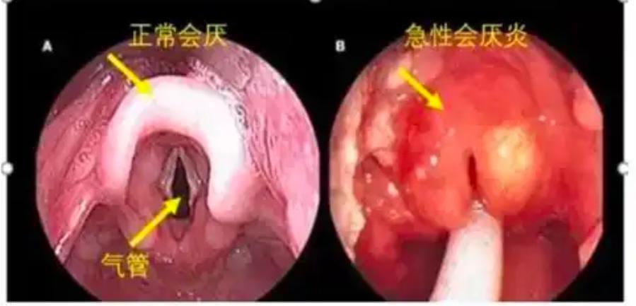 别轻视喉咙痛 急性会厌炎短时间夺命