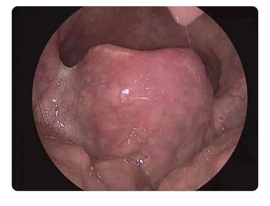 别轻视喉咙痛 急性会厌炎短时间夺命