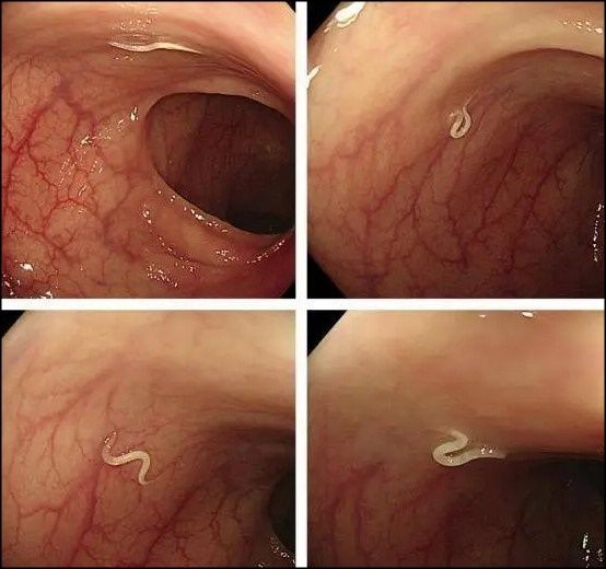 女子不明腹痛半年 医竟从肠道抓出白色活虫