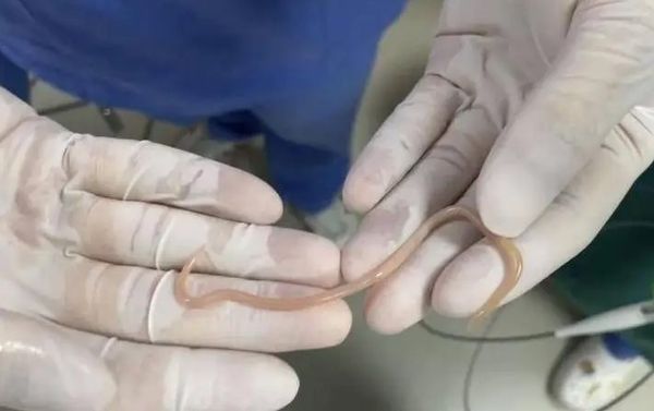女子不明腹痛半年 医竟从肠道抓出白色活虫