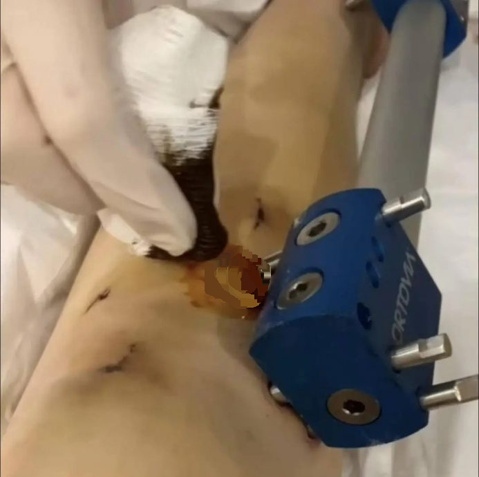 女子花37万元去土耳其“断骨增高” 岂料后遗症缠身 维权艰难