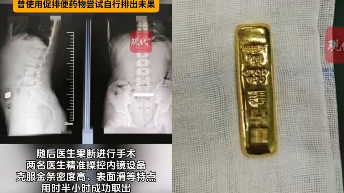 拚图) 苏州男童误吞“百克金条”急送医 