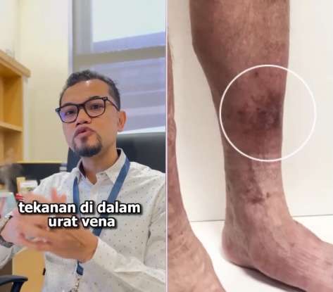 腿部常抽筋发痒？小心皮肤干裂 慢性溃疡！