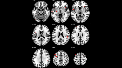 Working over 52 hours a week linked to structural brain changes, MRI study shows