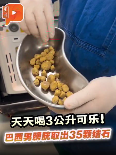 天天喝3公升可乐！巴西男膀胱取出35颗结石
