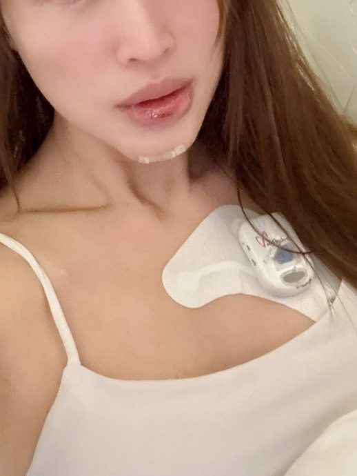 Amber Chia下巴缝10针 7颗牙齿受损喊心更痛