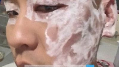 用餐厅纸巾擦汗 男子脸颊红肿“险毁容”