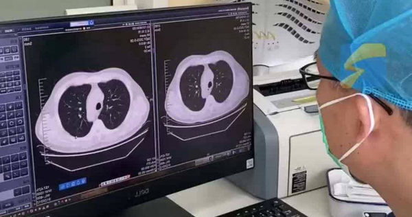 ​感冒狂咳嗽！高三男学生“左肺突消失”　医曝原因警告这类人小心