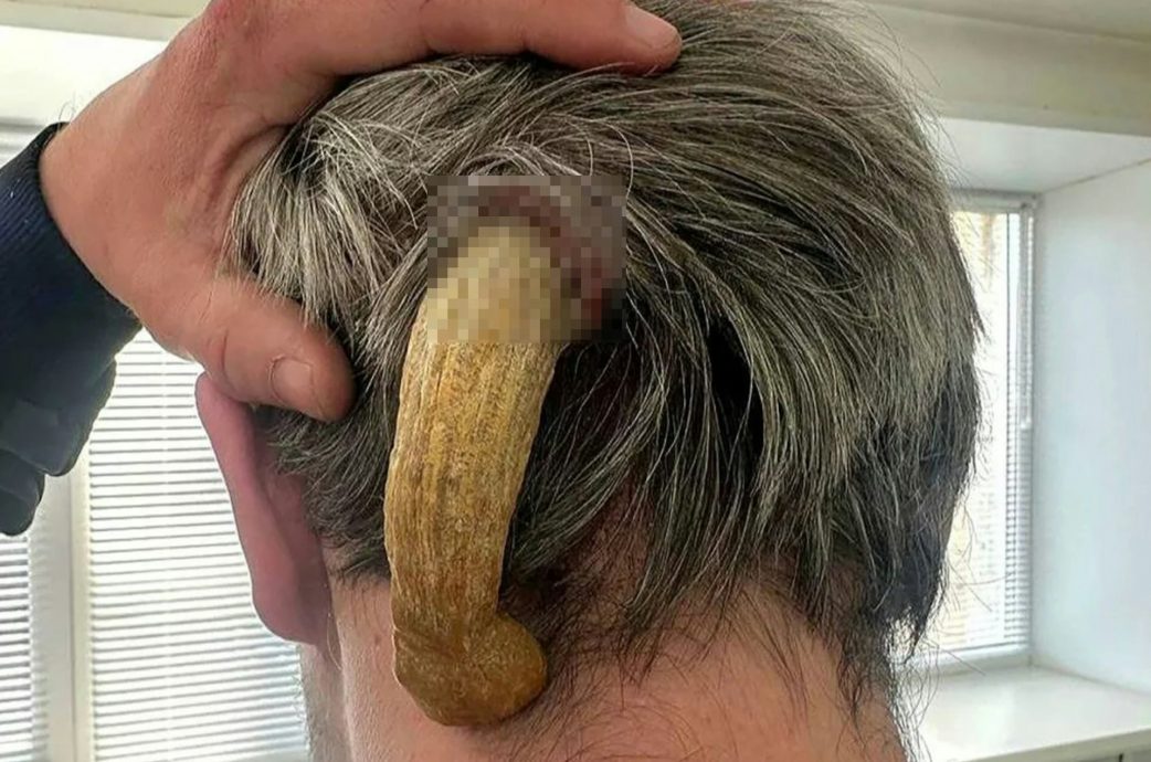 俄男后脑突长出“12公分恶魔角”吓呆外科医生：行医25年从未见过