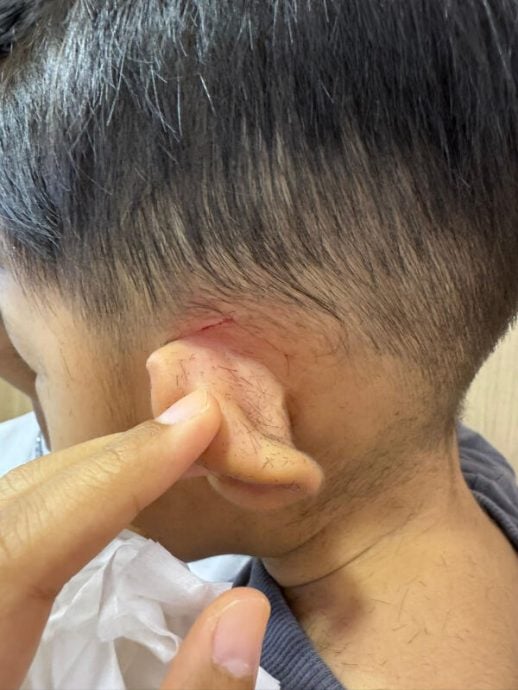 *已签发*柔:狮城二三事:幼童理发遭割伤耳 母诉老板“若无其事”