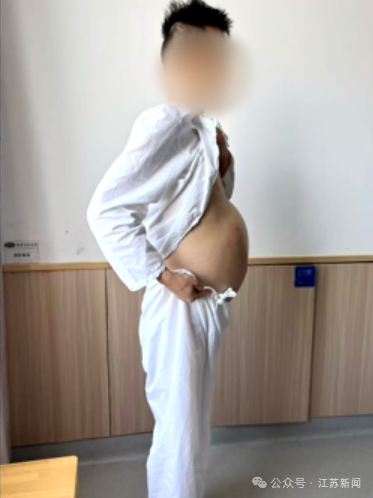 拼盘∕男子便秘4个月如怀孕 医生手术取出2公尺长“蟒蛇肠”