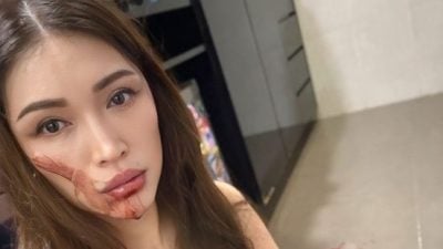 疑再因工作疲劳晕倒 Amber Chia下巴受伤入院动手术