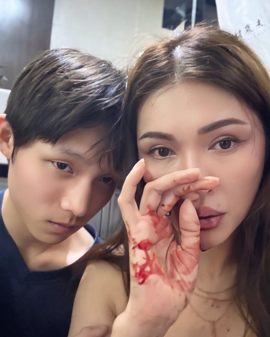 疑再因工作疲劳晕倒 Amber Chia下巴受伤入院动手术