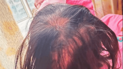 三岁女童铊中毒 疑为家庭纠纷遭投毒