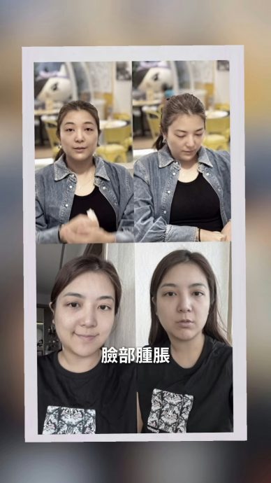 视频 | 受顽疾缠绕脸肿眼发炎 单文柔公开浮肿素颜照