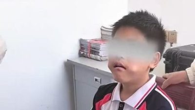 视频|男孩换牙期神操作！嘴卡三角尺全网傻眼