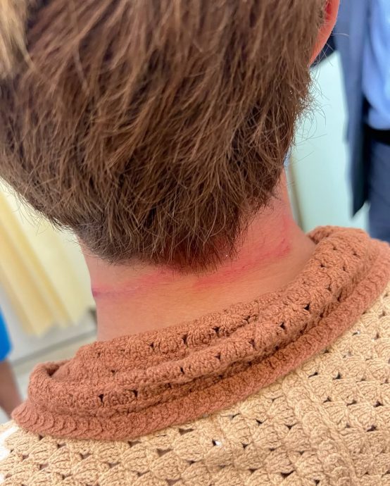 魏浚笙海上拍戏爆意外 颈部血痕触目惊心