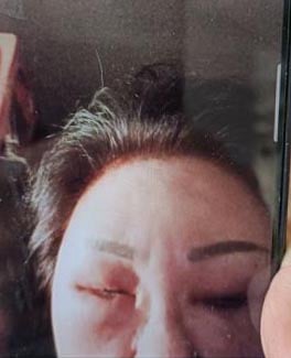 (已签发)柔:狮城二三事:老妇称染发后头皮流脓 理发院:染发时没反映有问题