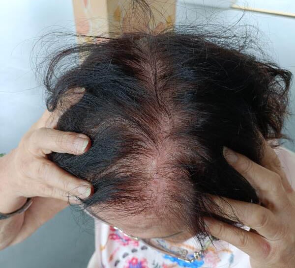 (已签发)柔:狮城二三事:老妇称染发后头皮流脓 理发院:染发时没反映有问题