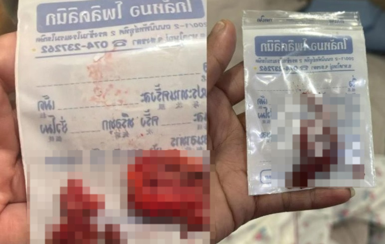 （有视频）取出脸部整形填充物 艺人妻子鼻梁下巴变歪 