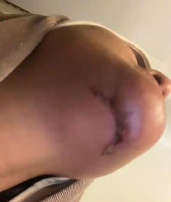 （有视频）取出脸部整形填充物 艺人妻子鼻梁下巴变歪 