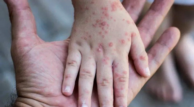 More than 4,300 HFMD cases reported in Sabah