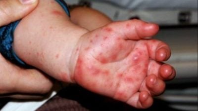 成人也中招   森3年逾1.8万手足口症