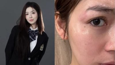 遭电卷棒砸脸被烫伤破相 刘倩妏控台发廊冷处理