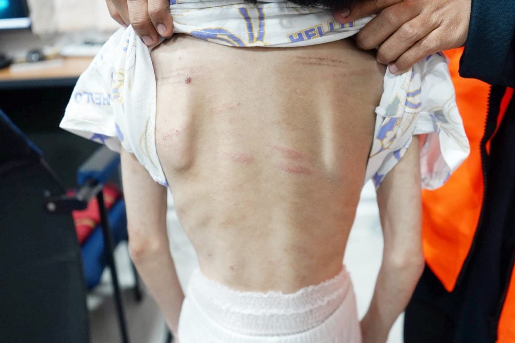 11岁华小生疑被父母虐待满身伤,父母落网前一天指顽皮鞭打女儿