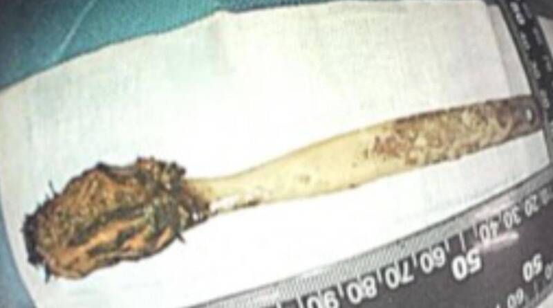 12岁误吞牙刷藏逾50年 中国64岁男胸痛求诊开刀取出