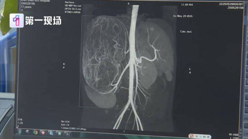 17岁女试穿裤子被店员提醒肚子太大 竟查出27公分超大肿瘤