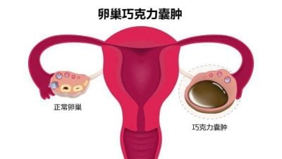 林韵璇 / 反式脂肪高糖助发炎 巧克力囊肿饮食禁忌