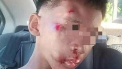 13岁男学生被一群野狗追摔伤 警展开调查