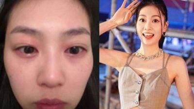 郭柏妍食物敏感眼部红肿 气管收缩：喘不过气