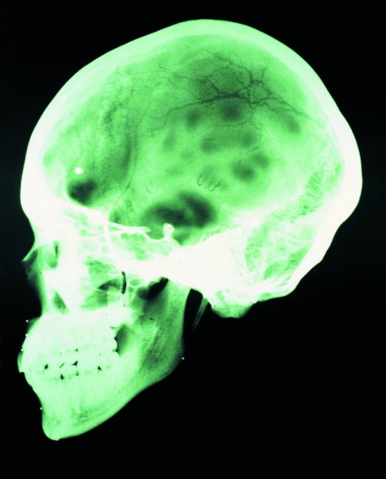 伤到脑犯罪几率大增? 哈佛研究“这个部位”最关键