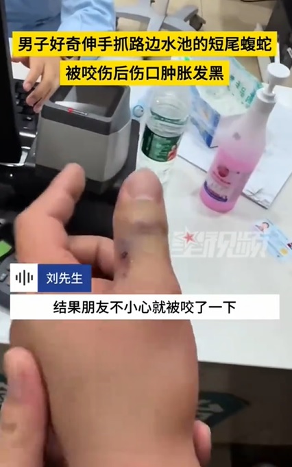 供星洲网：视频|男子好奇抓短尾蝮蛇被咬 手肿胀发黑急送医