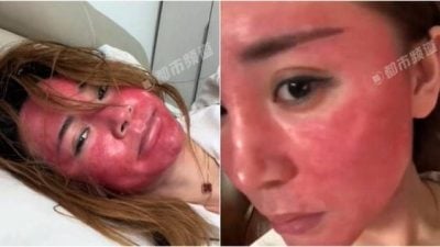 女子22年不卸妆 严重过敏变“关公脸”