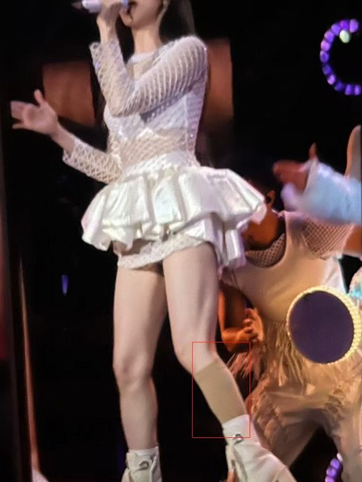 小腿绑绷带仍坚持开唱 王心凌为脚伤缝针感焦虑