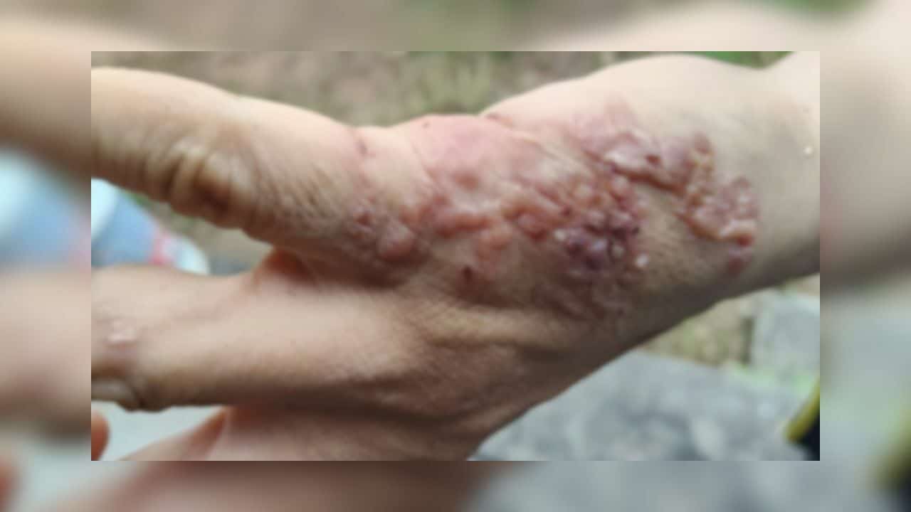 户外拔草致手长神秘水泡 男子感染“皮肤幼虫移行症”