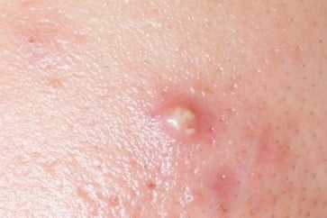 手挤痘痘酿悲剧 15岁少女细菌感染身亡