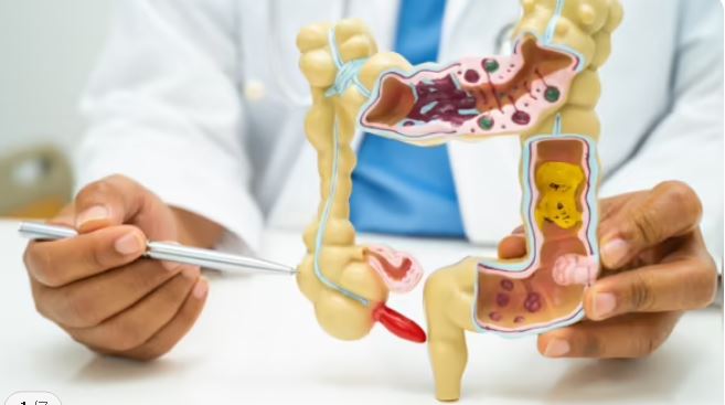 拼盘  研究: 阑尾癌年轻化 美千禧世代诊断率激增4倍
