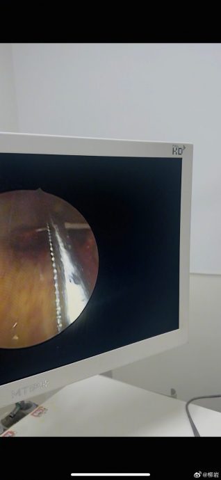 柳岩喝汤卡鱼刺急就医 竟被嘲小题大作