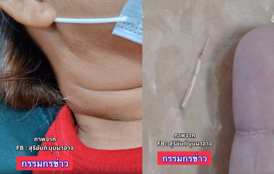 泰女喝鱼汤误吞2cm鱼刺 2周后喉咙被穿破速动刀取出