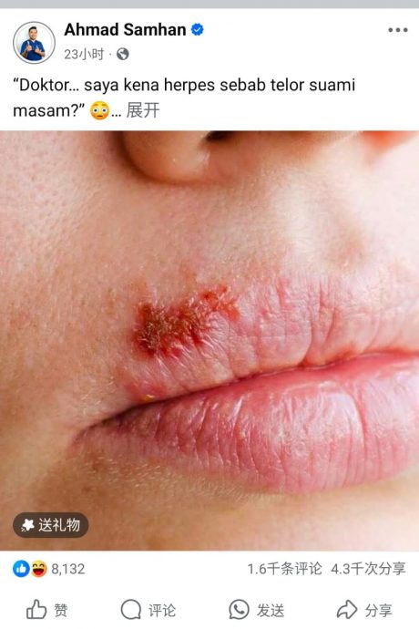 男人“蛋蛋”有怪味不一定是性病 疱疹感染源自很多渠道