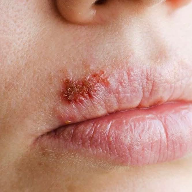 男人“蛋蛋”有怪味不一定是性病 疱疹感染源自很多渠道