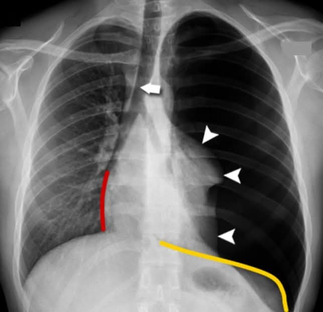 男子气胸急诊  忏悔发誓戒烟