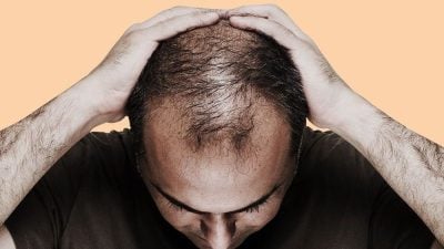 科学家发现两种植物萃取物可治疗脱发