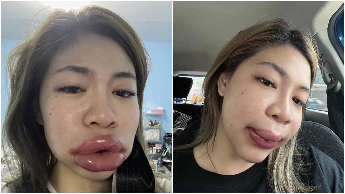 美了还要更美 女子注射玻尿酸 唇肿如香肠