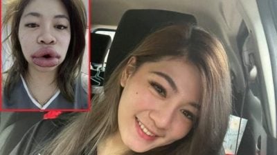 美了还要更美 女子注射玻尿酸 唇肿如香肠