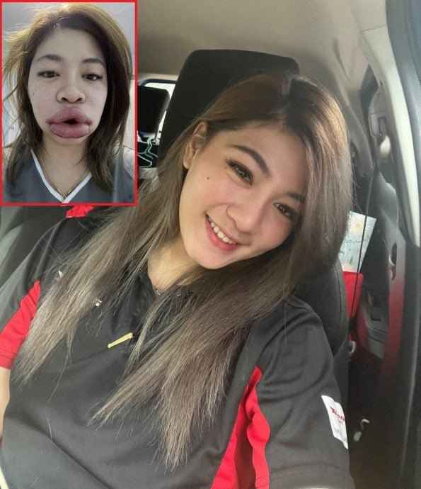 美了还要更美 女子注射玻尿酸 唇肿如香肠